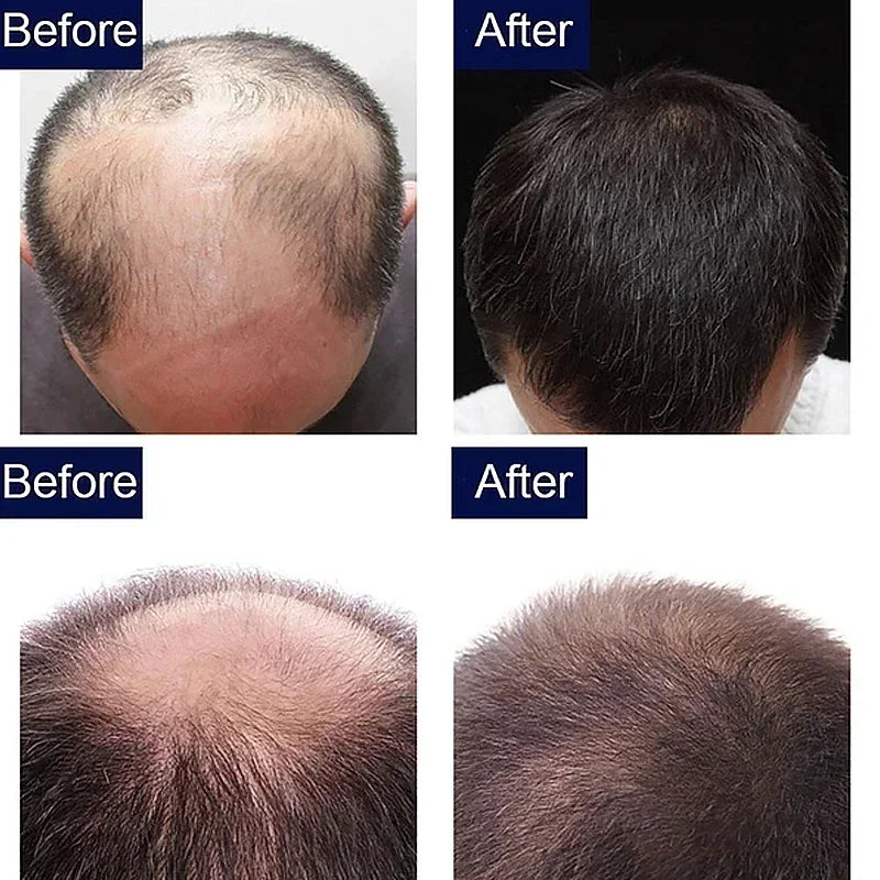 OUHOE Anti-Hair Loss Growth Serum